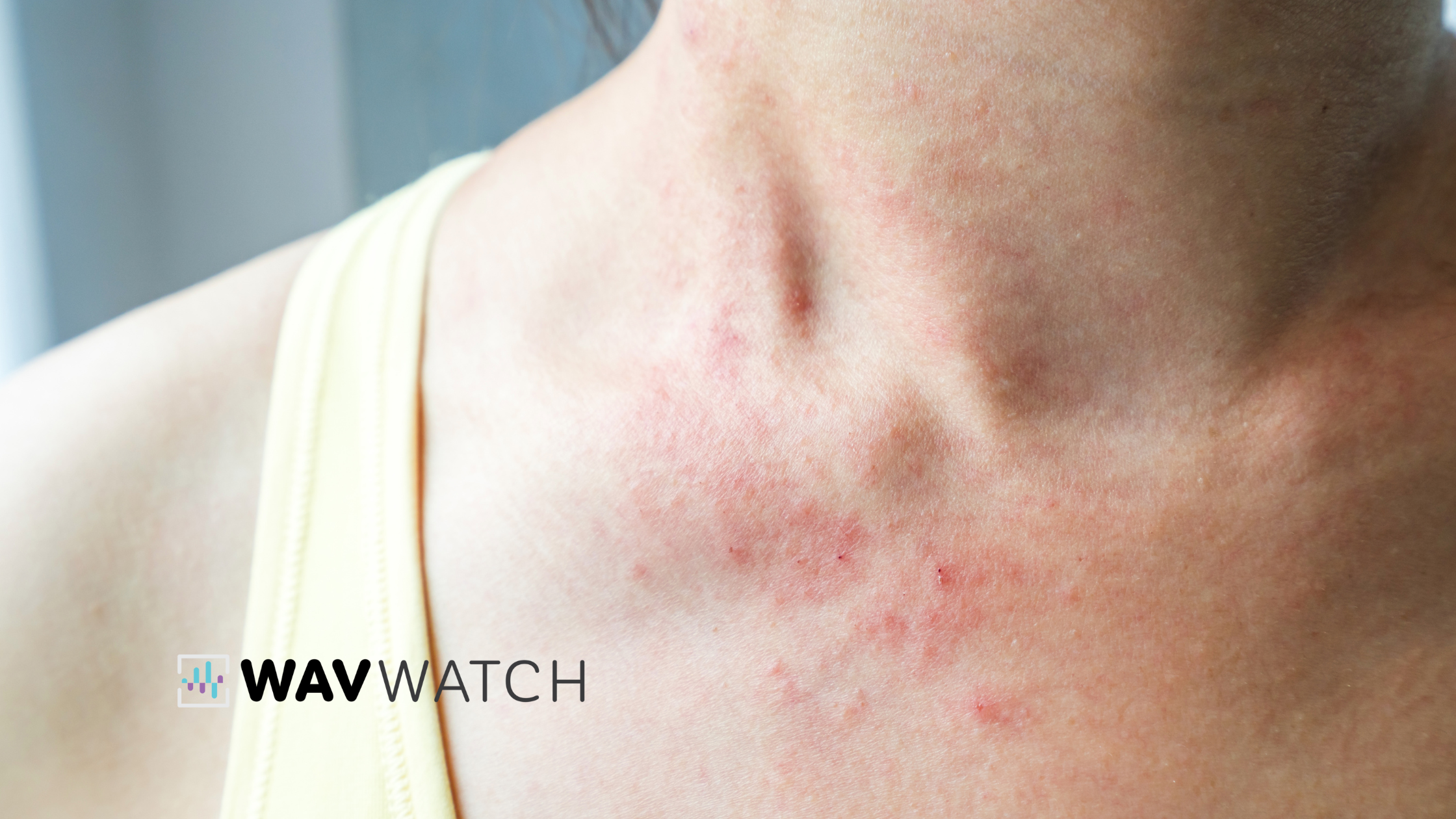 Image of Menopause Skin Rash and Hives