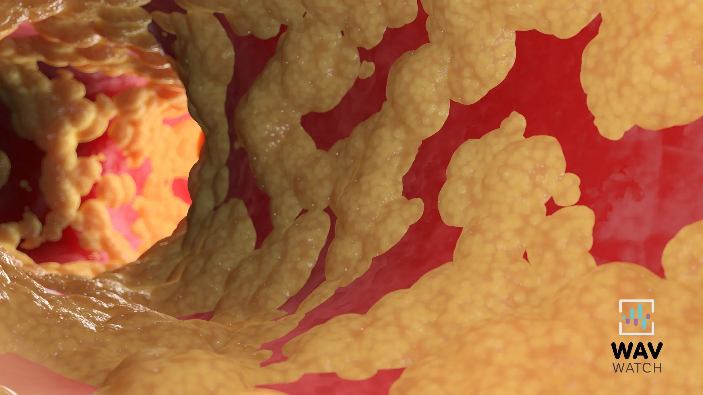Graphic of Fatty Liver Disease