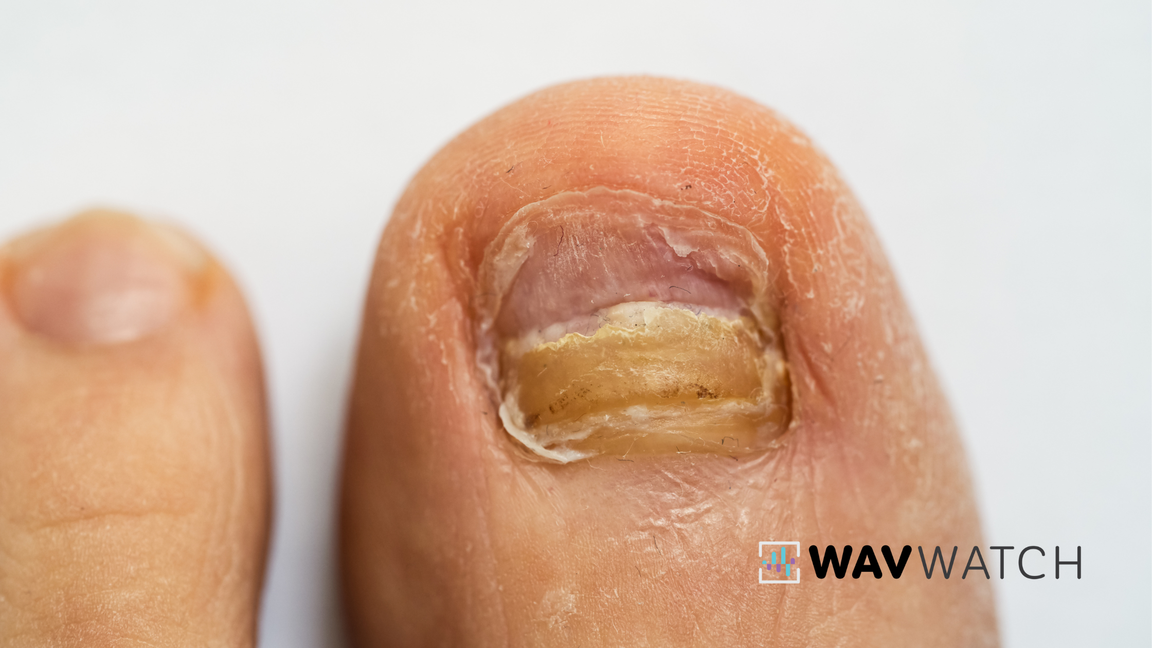 Image of Toe Fungal Infection