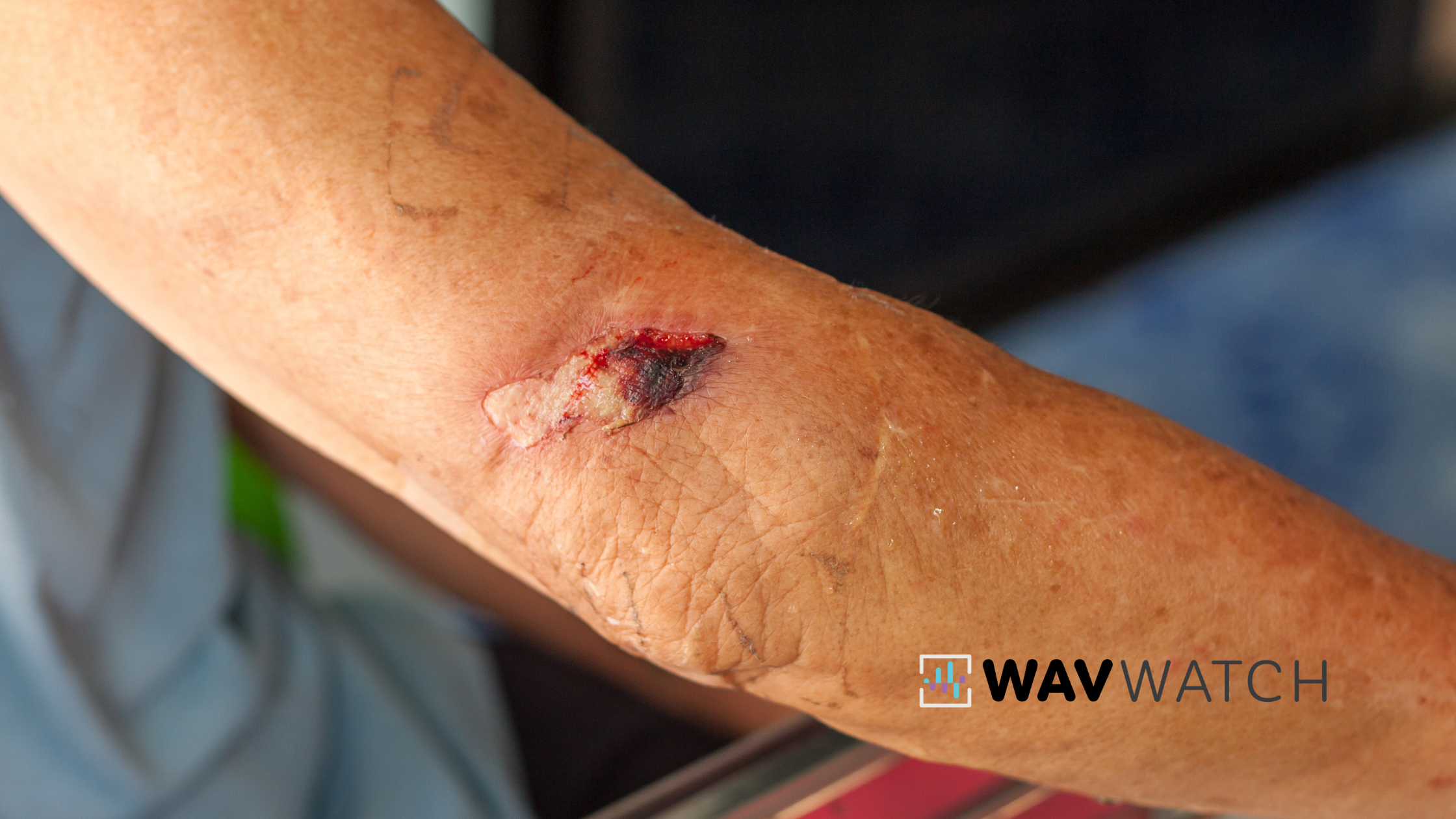 Image of Wound on Arm