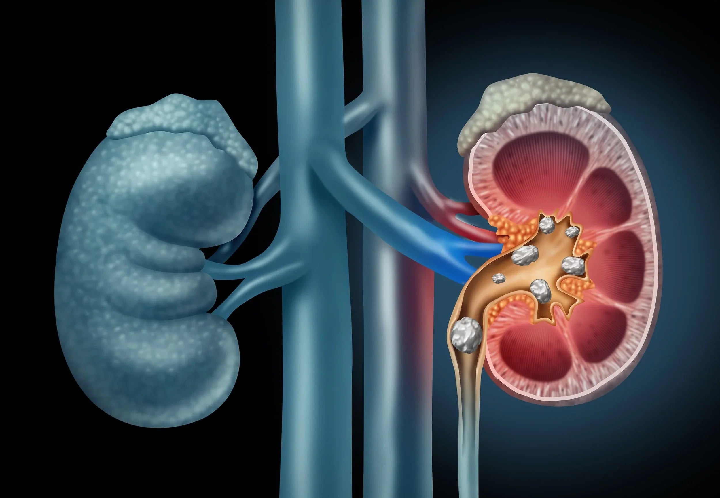 Graphic Image of Kidneys with Stones