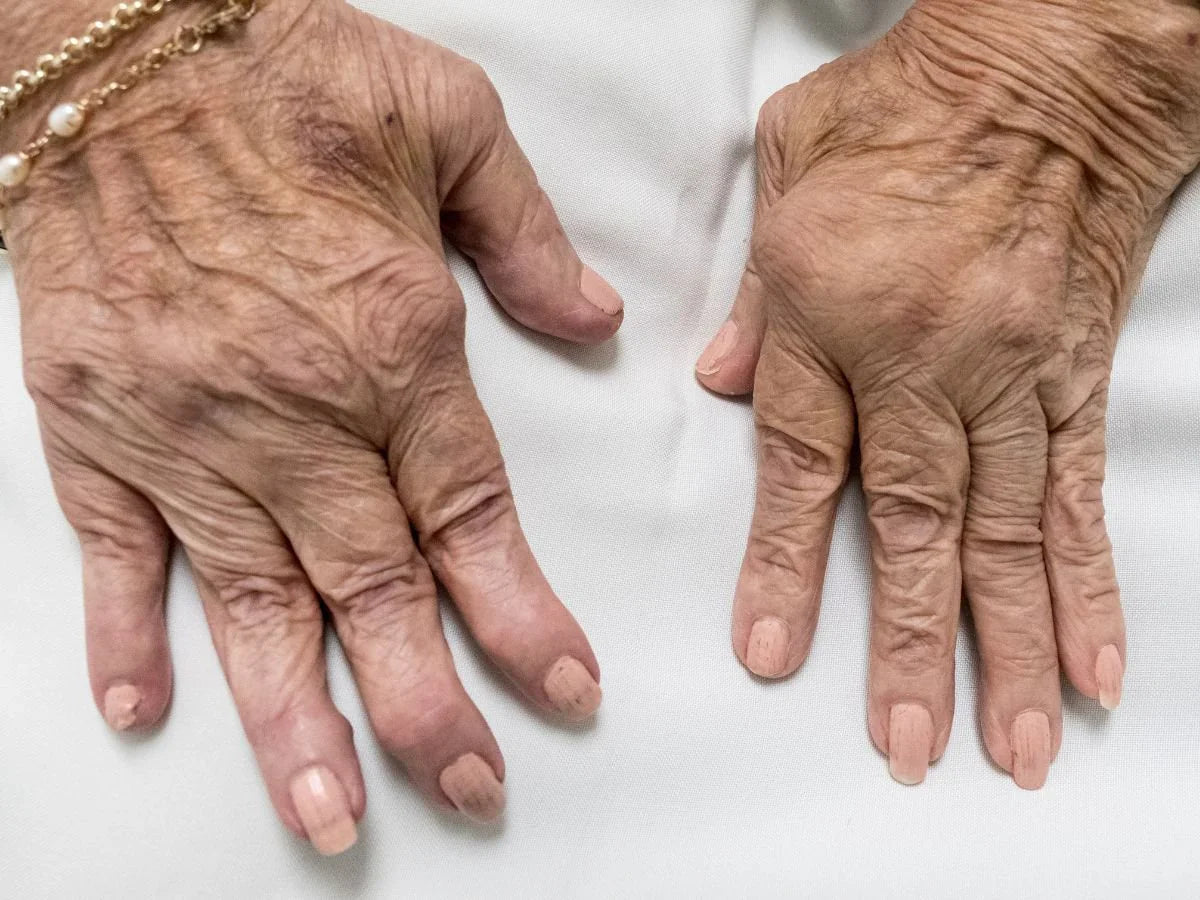 Image of Woman's Hands with Rheumatoid Arthritis